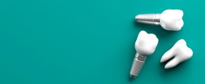 Преимущества установки зубных имплантов